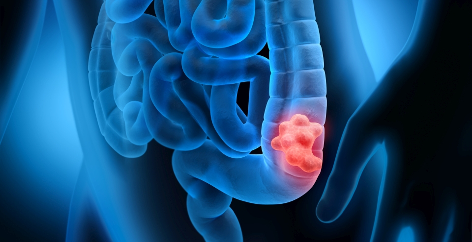 Colorectal Cancer Illustration