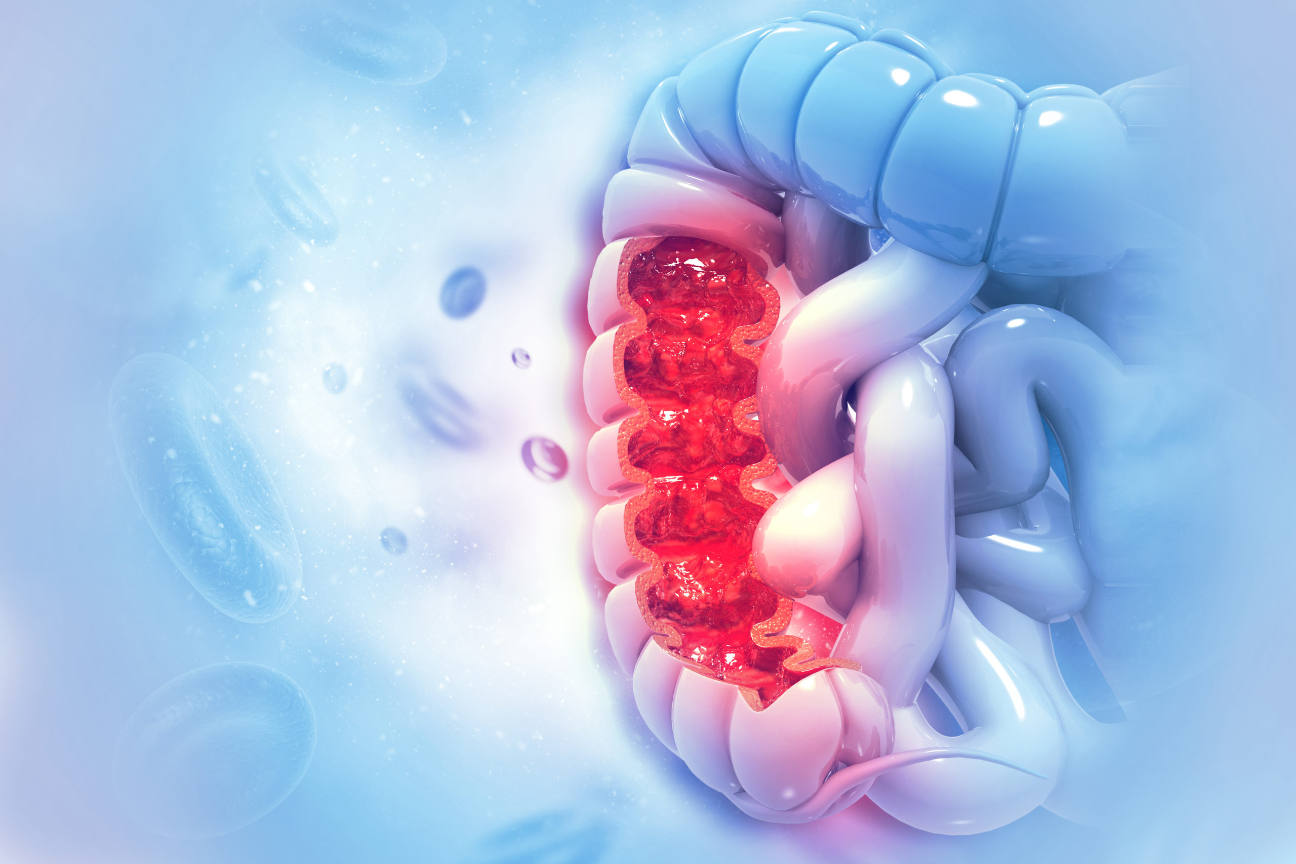 Colon cancer. Colon disease concept