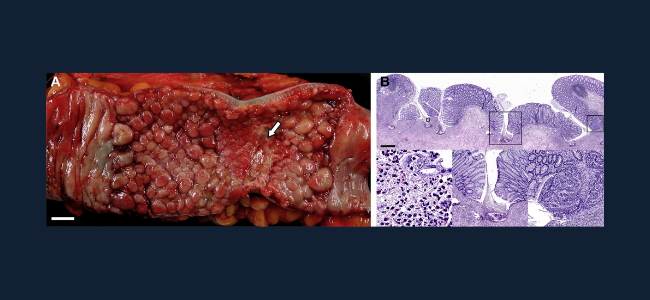 Copy of Biosimilar_Brochure_Gastro