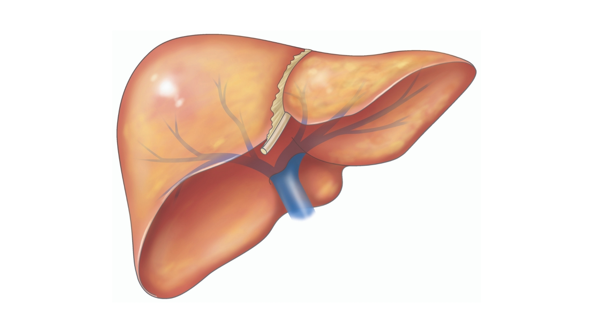 NAFLD-liver-scaled_1920x1080