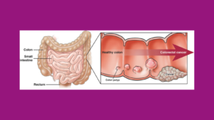 Colorectal Cancer