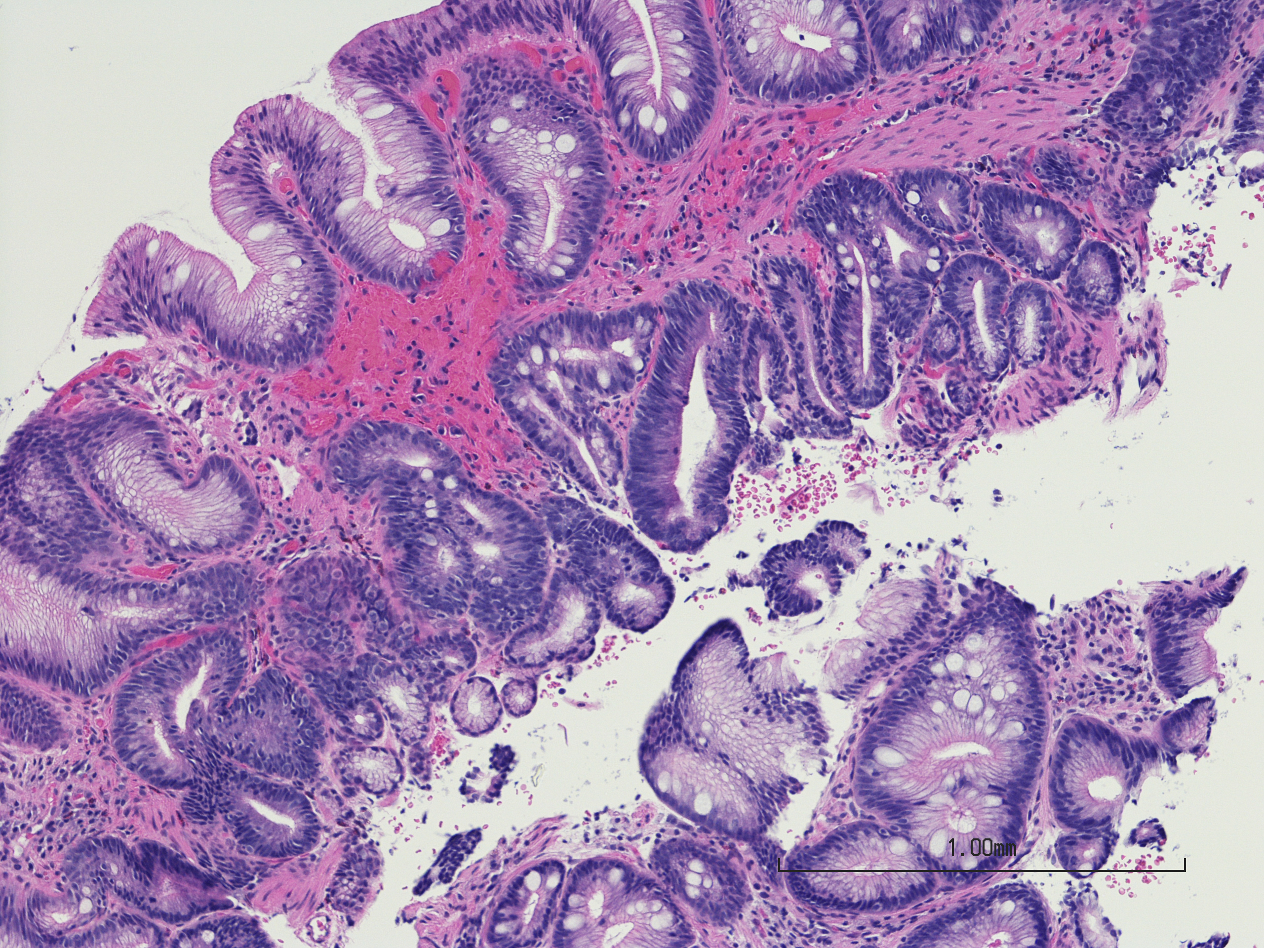 Microscopic photo of a professionally prepared slide demonstrating intestinal metaplasia of the esophagus. Barrett's esophagus caused by gastroesophageal reflux disease. Chronic esophagitis.