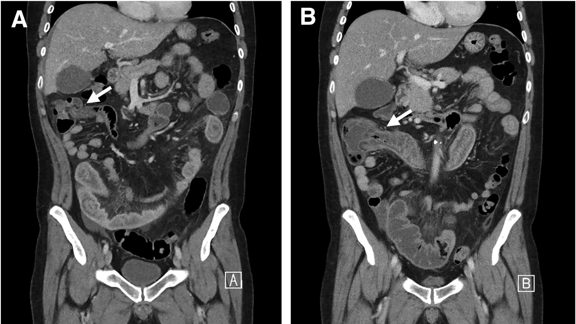 Image challenge: A rare cause of small bowel thickening - American ...