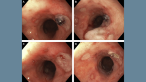 Coronavirus Associated Bleeding Esophageal Ulcerations