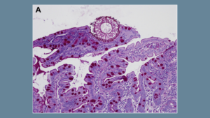 An Unexpected Guest in a Patient With Ulcerative Colitis