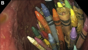 Foreign body ingestion image of crayons