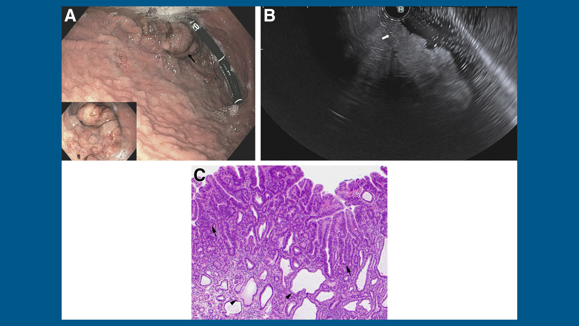 A distinct and potentially deadly cause of gastric polyposis