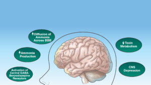 Missing the Mark: Hepatic Encephalopathy