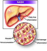 NASH medical diagram