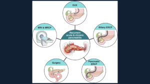 Pancreatitis CPU graphic