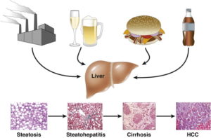 NAFLD Diagram