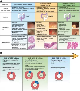 Chart of clinical, endoscopic, and histologic characteristics of the different serrated polyps