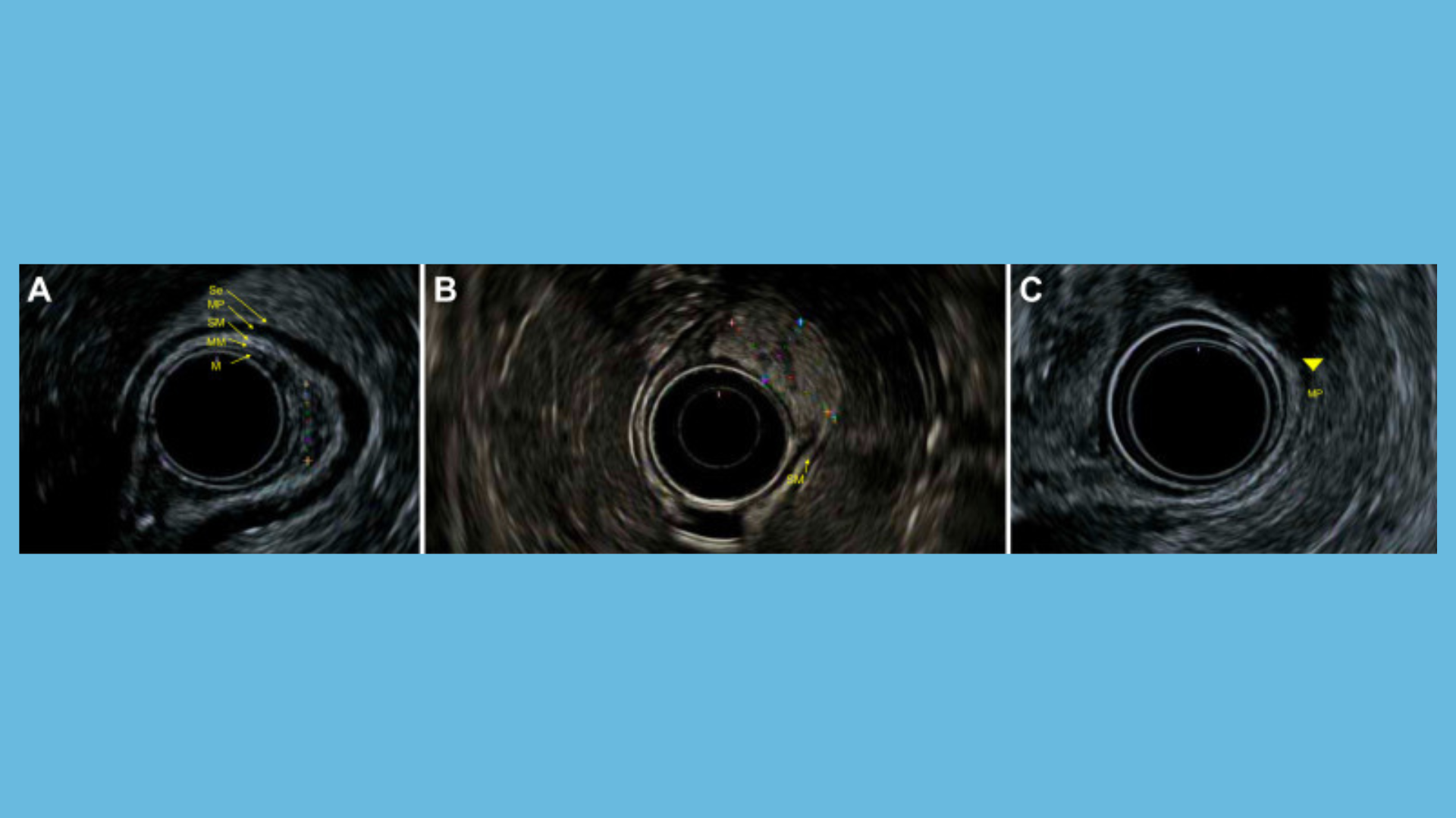 CPU Subepitheliallesions