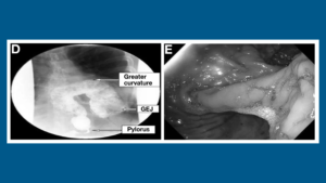 Scans of patient with gastric rotation in stomach