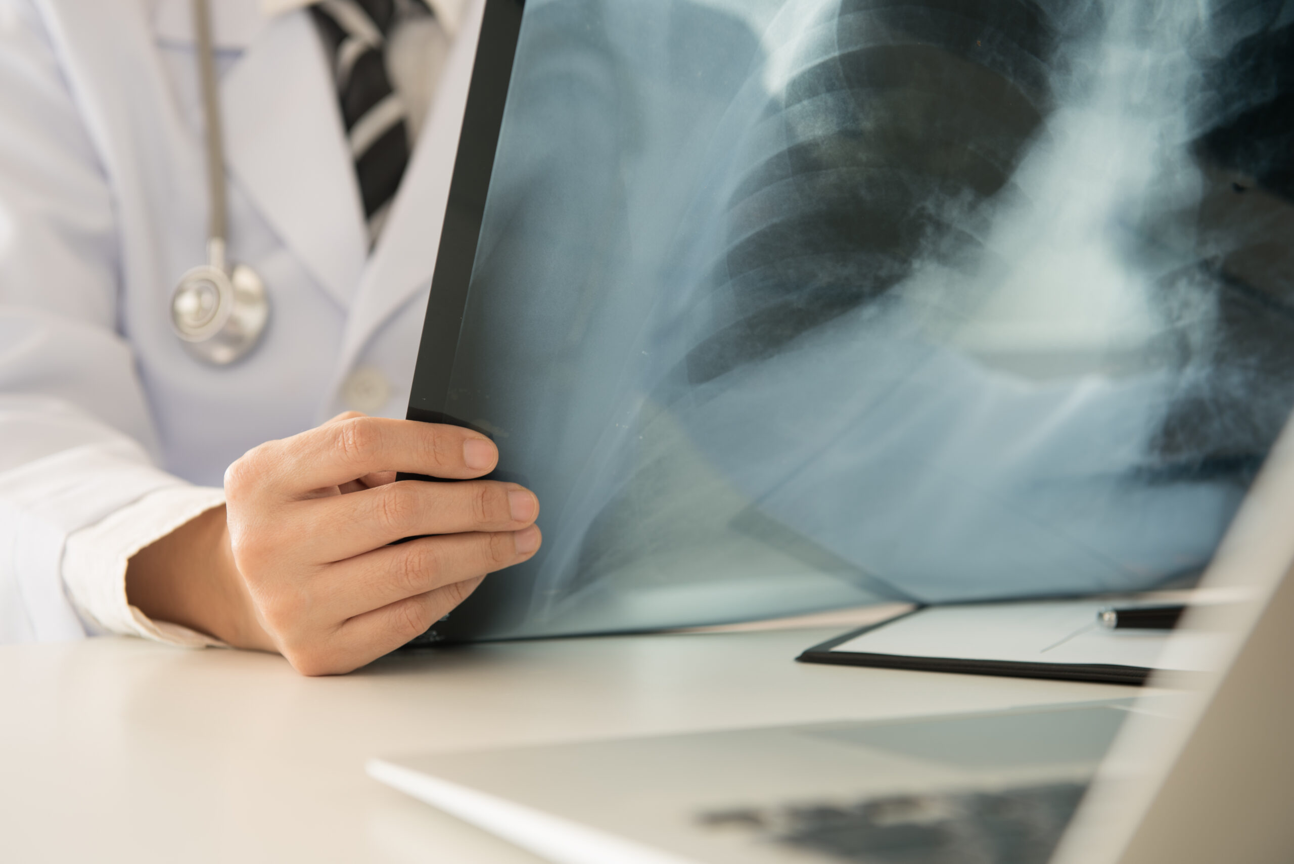 Radiologist doctor examining at lungs radiograph x-ray film of patient in roentgen room.