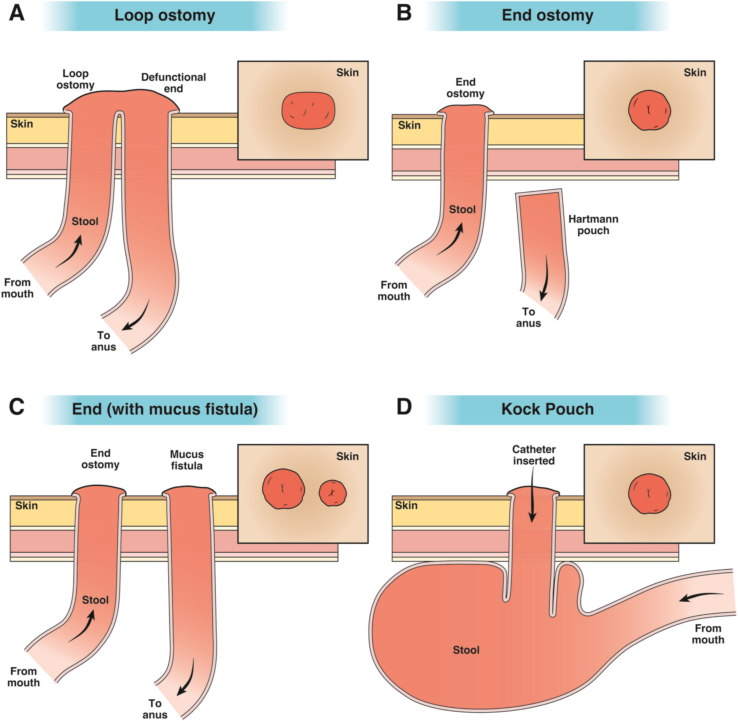 Schematic of different types of ostomy configurations including the (A) loop ostomy, (B) end ostomy with Hartmann’s pouch, (C) end ostomy with mucus fistula, and (D) the continent ileostomy (Kock pouch).