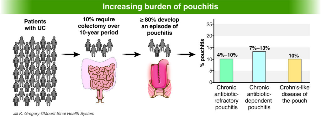 Increasing burden of pouchitis spotlight