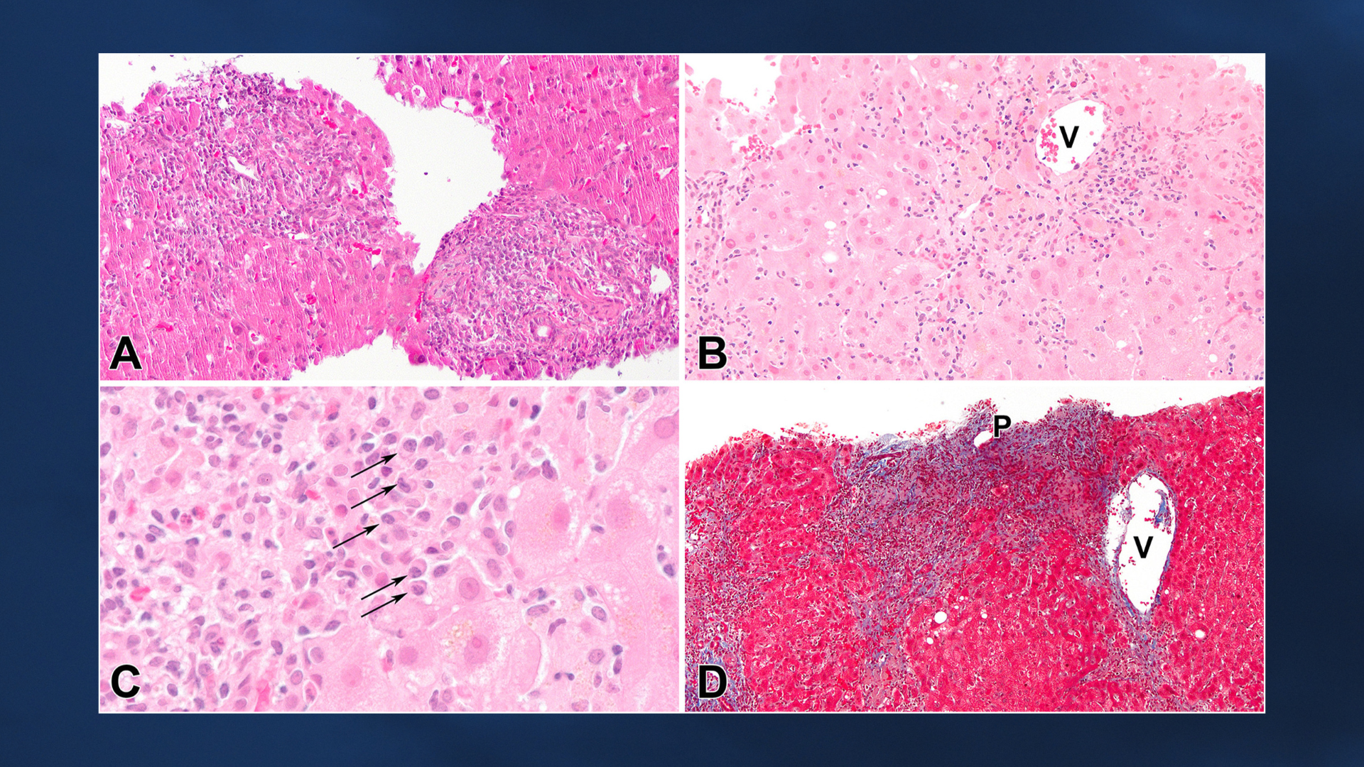 Gastro Grand Rounds Hepatitis
