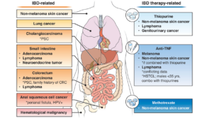 IBD Malignancy Figure