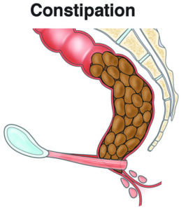 Constipation graphic