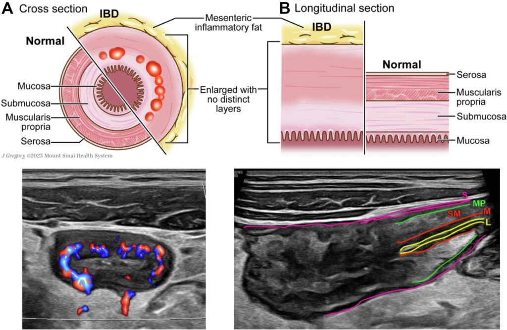 AGA Clinical Practice Update on the Role of Intestinal Ultrasound in Inflammatory Bowel Disease: Commentary