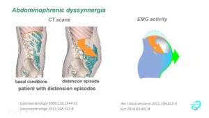 Gastro Journal Club Biofeedback Treatment for Abdominal Distention