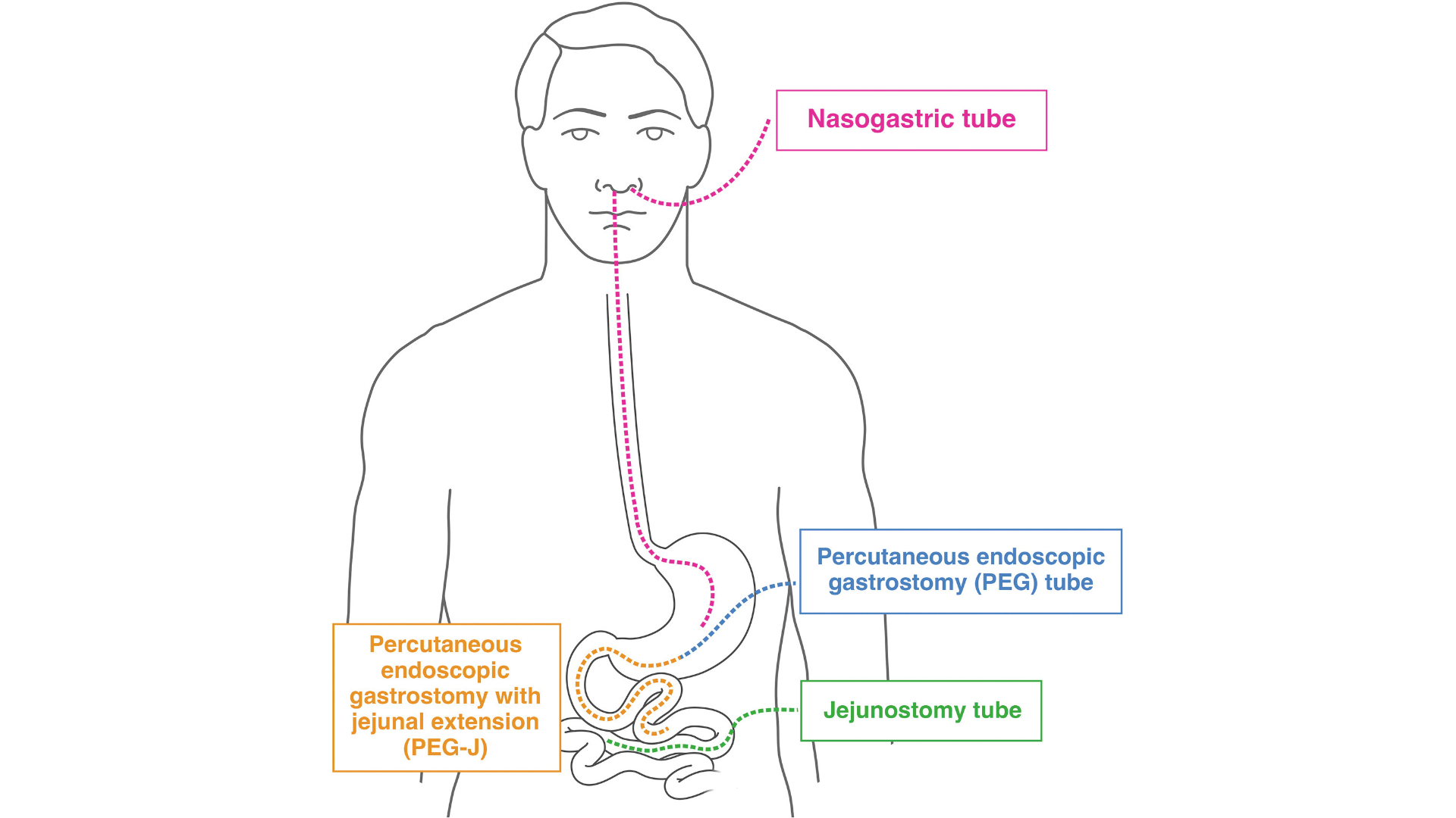 Best practices for endoscopic enteral access