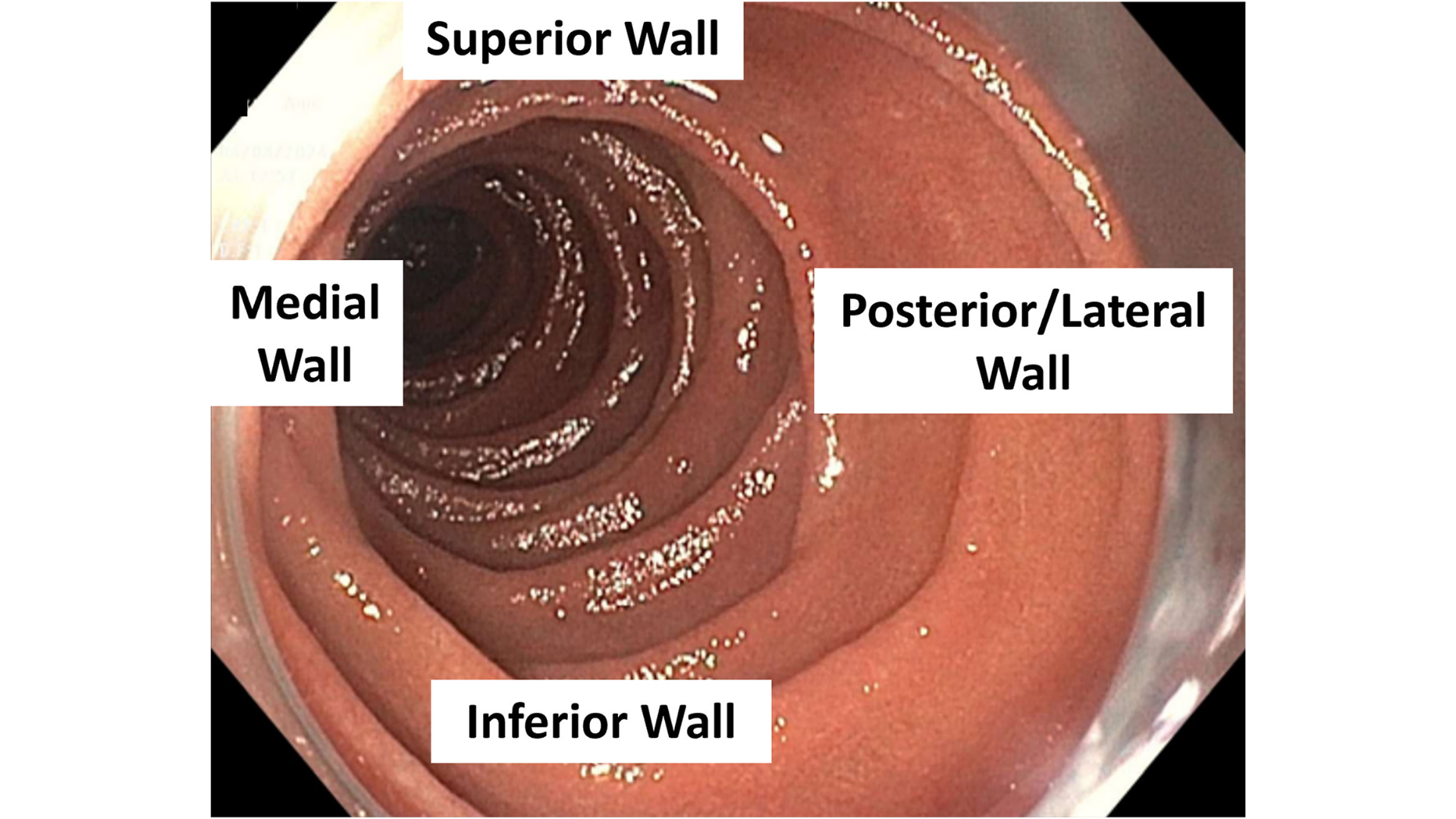 Nonampullary duodenal lesions
