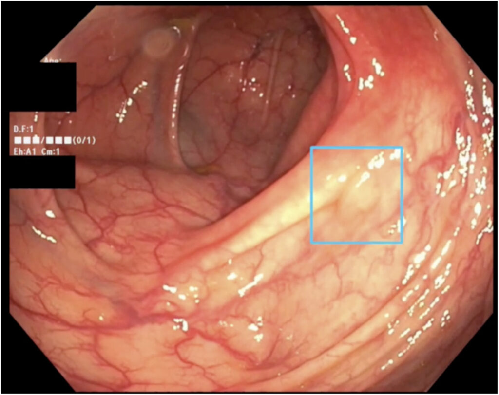 AI for colonoscopy