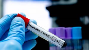 Hepatitis C