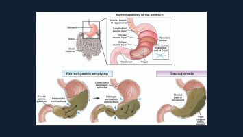 2019DiabeticGastroparesis 2019DiabeticGastroparesis