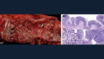 Copy of Biosimilar_Brochure_Gastro Copy of Biosimilar_Brochure_Gastro