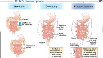 Disease Disease