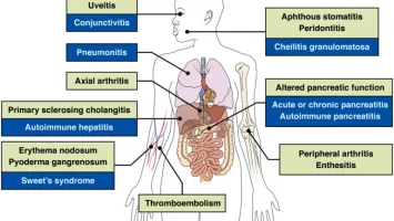 EIMS-of-IBD_GastroReview-scaled