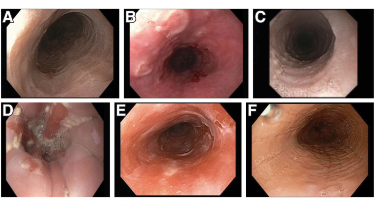 Esophageal Dysfunction CPU