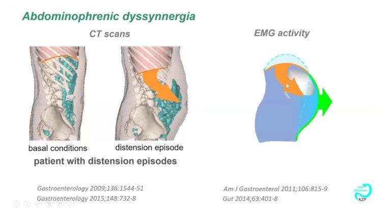 Gastro Journal Club Biofeedback Treatment for Abdominal Distention