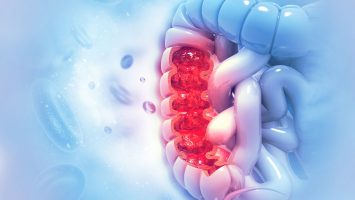 Colon cancer. Colon disease concept Colon cancer. Colon disease concept
