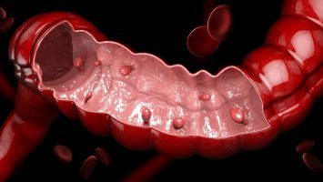 3d illustration of Colon polyps. Polyp in the intestine. isolated black.. Colon polyps