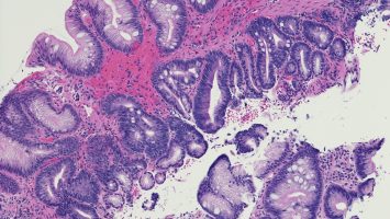 Intestinal metaplasia of the esophagus- Barrett’s esophagus. Microscopic photo of a professionally prepared slide demonstrating intestinal metaplasia of the esophagus. Barrett's esophagus caused by gastroesophageal reflux disease. Chronic esophagitis.
