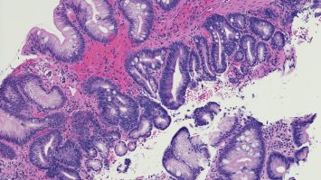 Microscopic photo of a professionally prepared slide demonstrating intestinal metaplasia of the esophagus. Barrett's esophagus caused by gastroesophageal reflux disease. Chronic esophagitis.