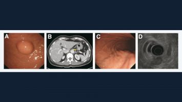 Image Challenge: An Unusual Cause of Recurrent Subepithelial Mass in the Stomach