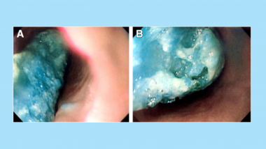 Image Challenge: Blue Foreign Body in the Esophagus