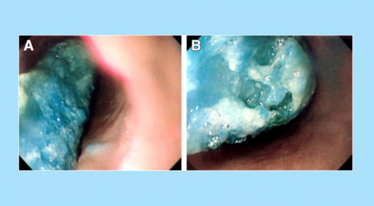 Image Challenge: Blue Foreign Body in the Esophagus