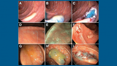 Endoscopic images of 3 different SSLs before and after resection.