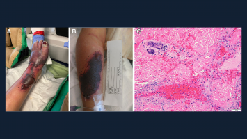 A Rare But Devastating Dermatologic Manifestation of Ulcerative Colitis