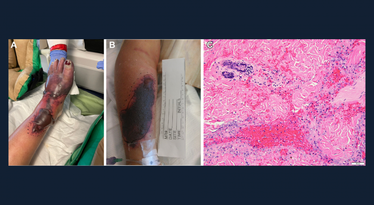 A Rare But Devastating Dermatologic Manifestation of Ulcerative Colitis