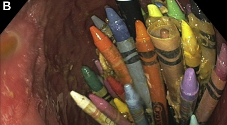 Foreign body ingestion image of crayons