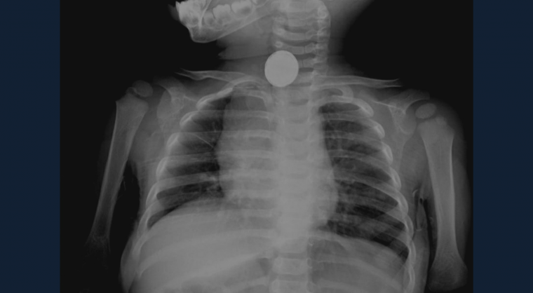 X-ray image of person swallowed coin