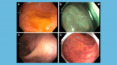 Strengths and Weaknesses of an Artificial Intelligence Polyp Detection Program as Assessed by a High-Detecting Endoscopist