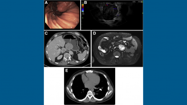 Multiple Tumors in a Young Patient